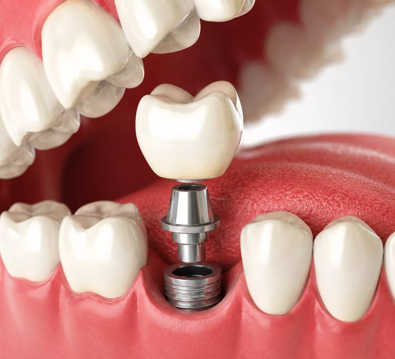 Dental Implants