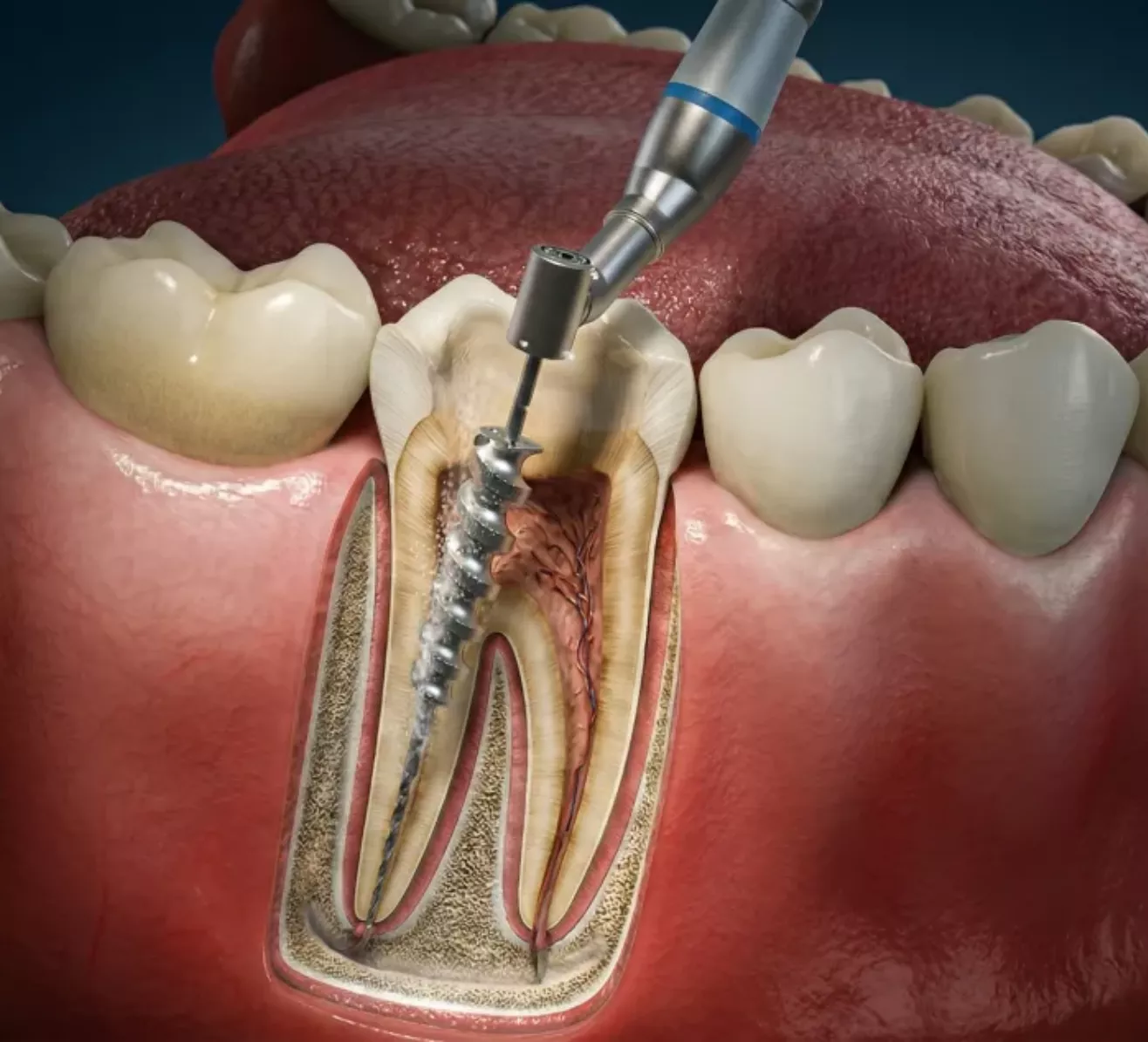 root canal